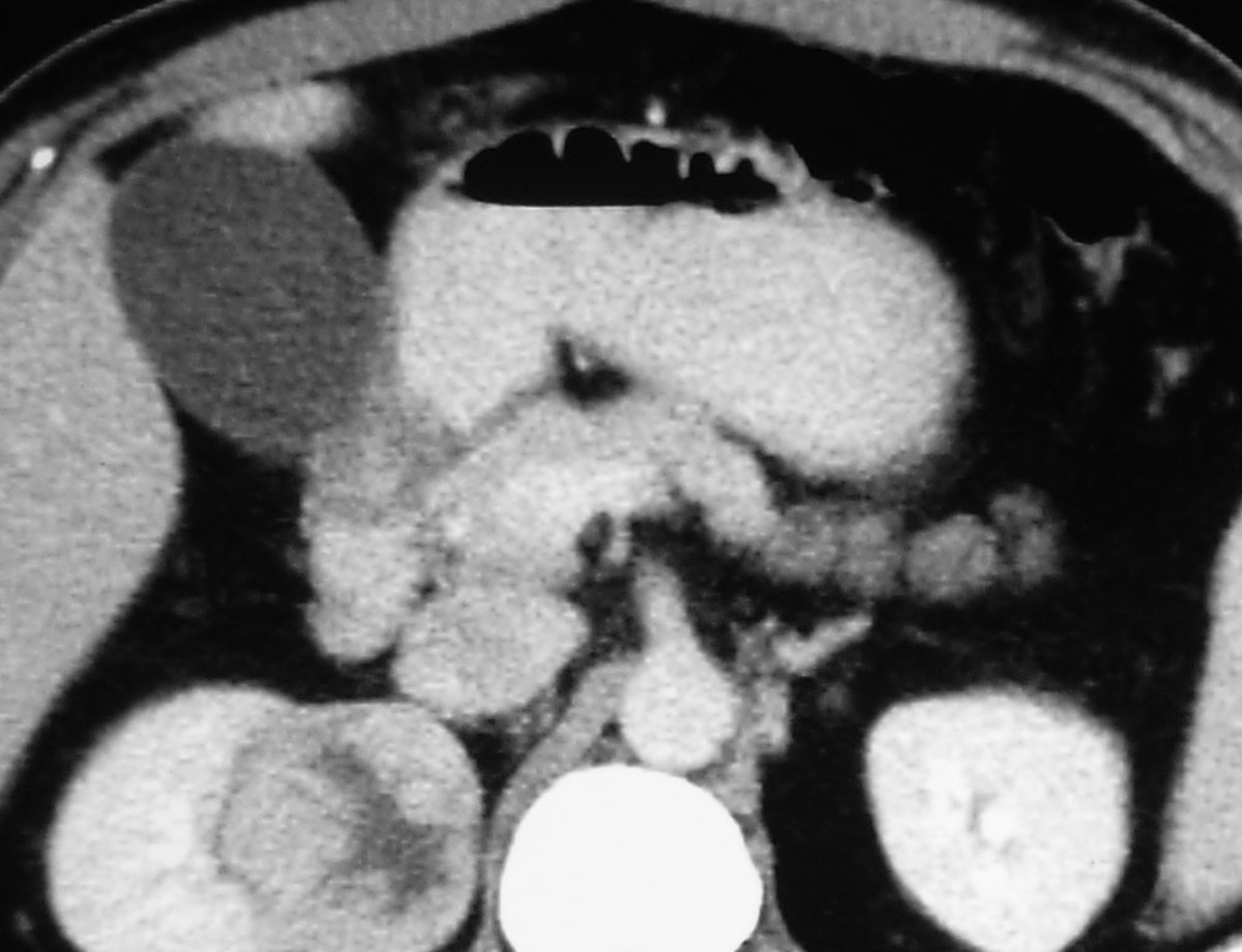 Contrast-enhanced CT scan of the abdomen showing a solid tumour in the right kidney